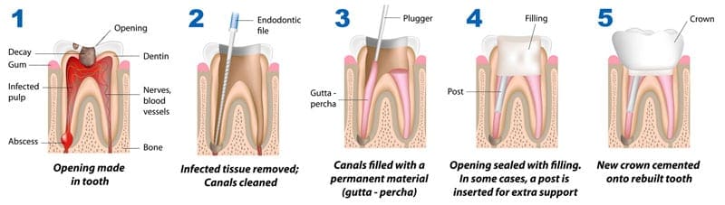 Family Dental Care - Campbelltown - Root Canal Therapy - stages