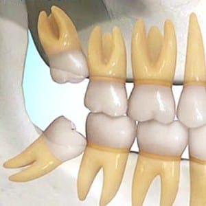 Campbelltown Family Dental Care Wisdom Teeth