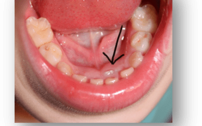 Lower Incisor Crowding