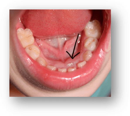 Lower Incisor Crowding