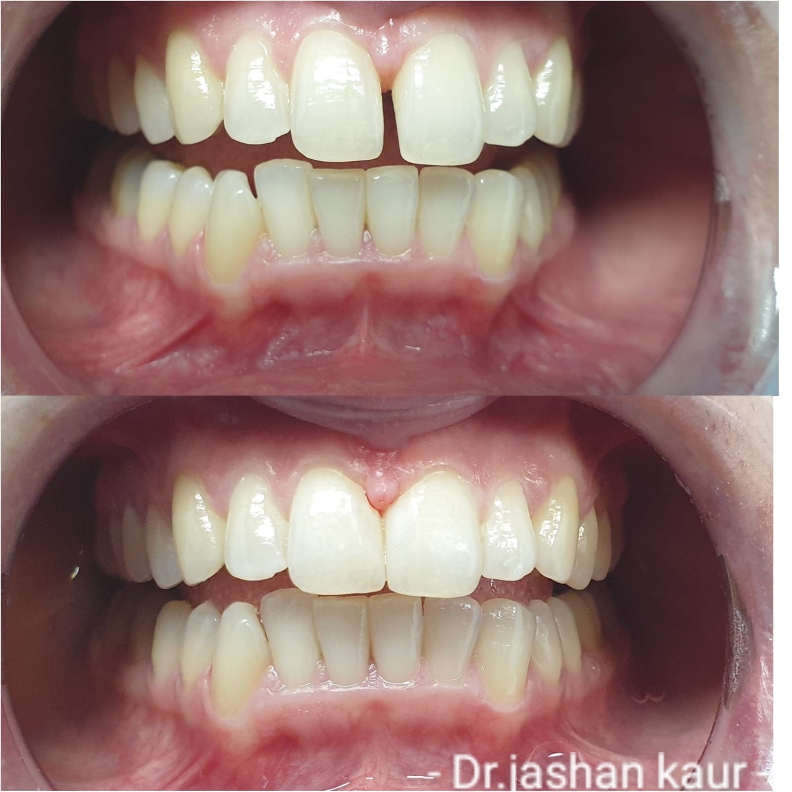 Campbelltown Family Dental Care Composite veneer 19-11-20