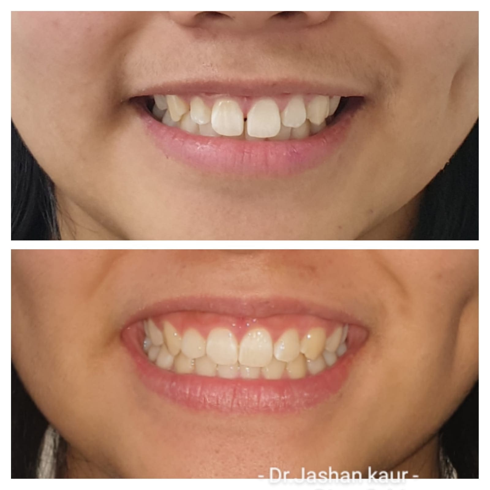 Campbelltown Family Dental Care Composite veneer 19-11-20