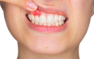 What Causes Mouth Sores? Tips to Treat and Prevent Them