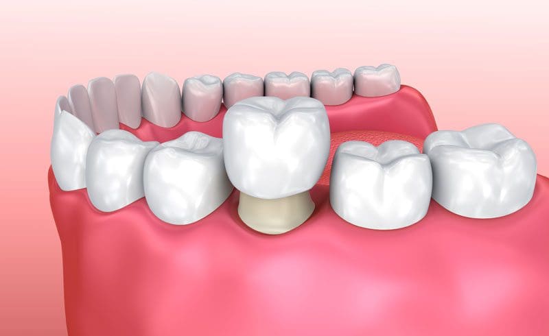 about crowns and dental bridges