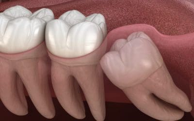 Common wisdom tooth problem and how to deal with them