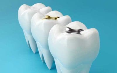 How Long Do Dental Fillings Last? Will They Fall Out?