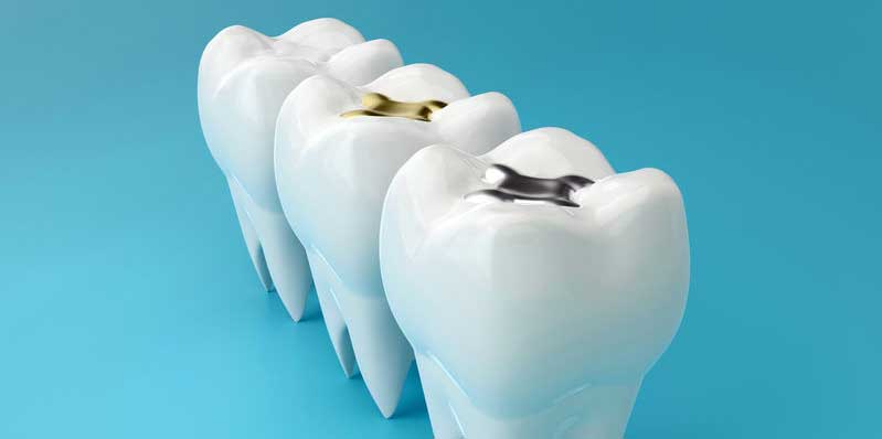 Dental Fillings Last