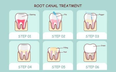 Step by Step Explanation of Root Canal Treatment Procedure