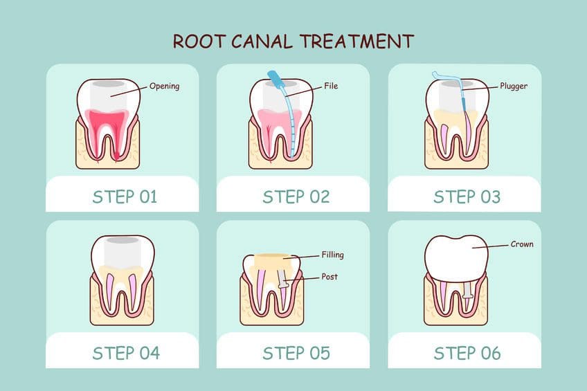 Root Canal Treatment procedure