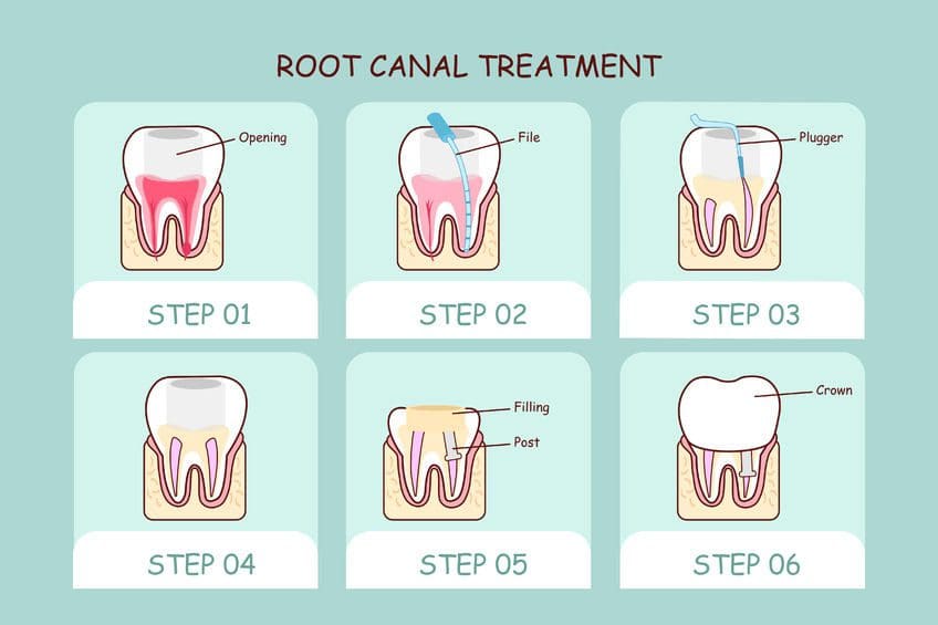 Step by Step Explanation of Root Canal Treatment Procedure