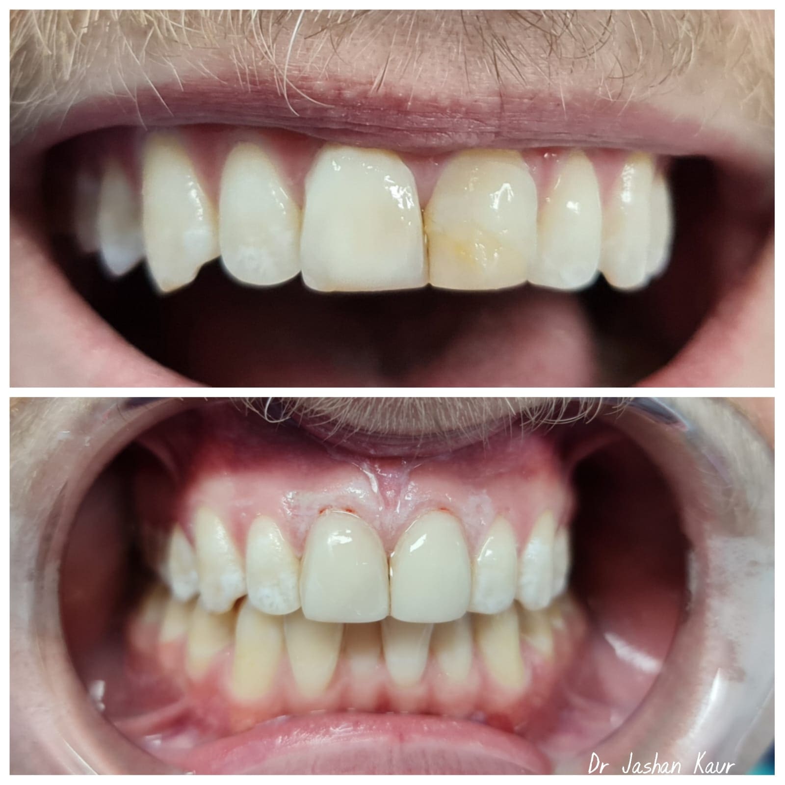 Campbelltown Family Dental Care Composite veneer 19-11-20