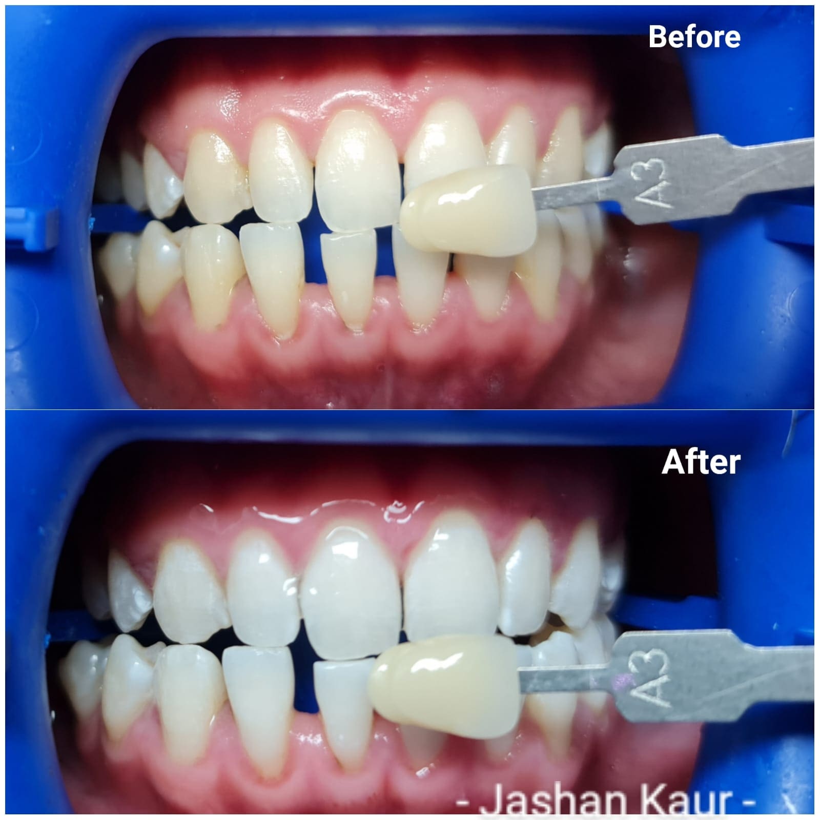 Campbelltown Family Dental Care Composite veneer 19-11-20