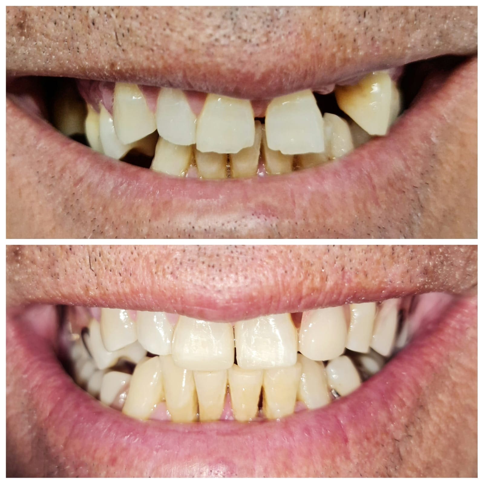 Campbelltown Family Dental Care Composite veneer 19-11-20