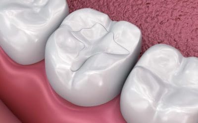 Common dental fillings used to treat cavities
