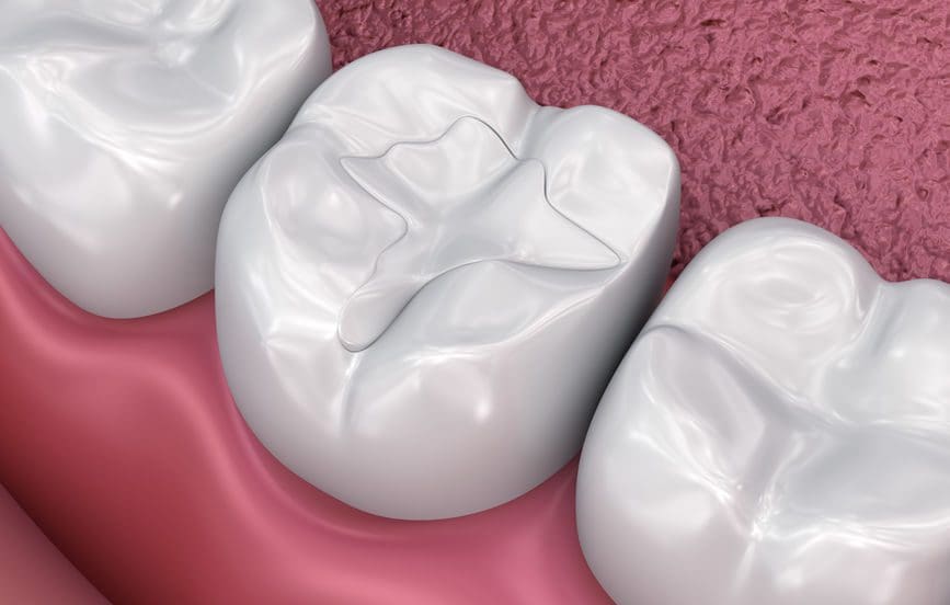 Common dental fillings used to treat cavities