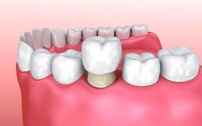 All you need to know about crowns and dental bridges